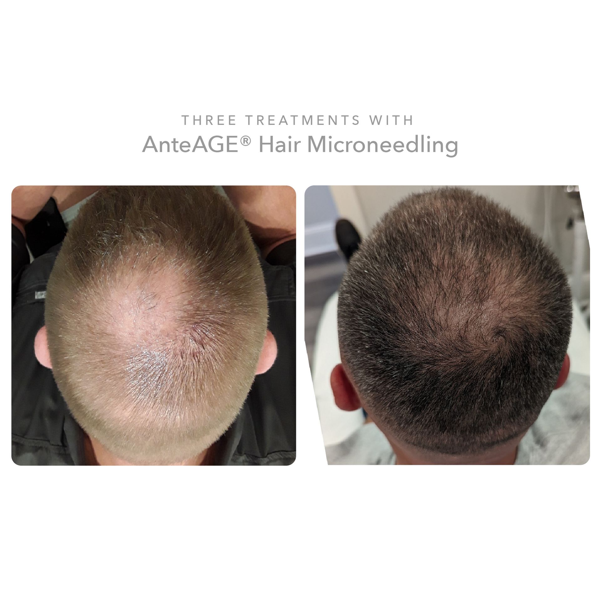 Hair loss - before and after photos