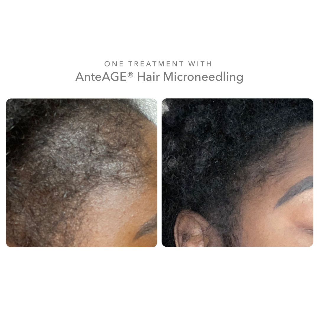 Person with hair loss - before and after photos