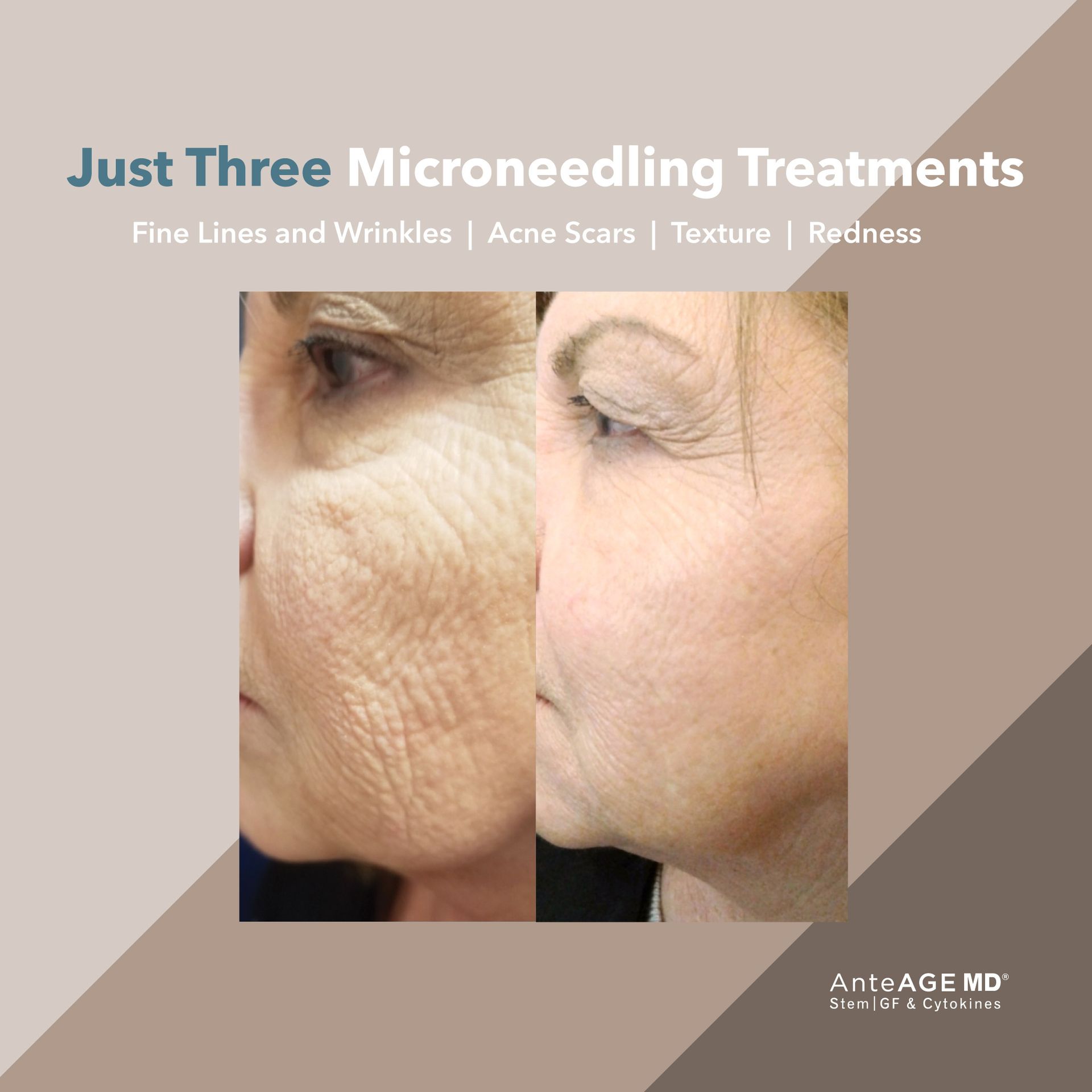 real patient shown before and after treatment with AnteAGE®