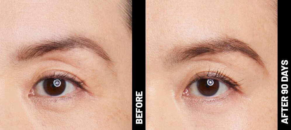 real patient real patient shown before and after treatment with Ultherapy® before and after treatment with Ultherapy®