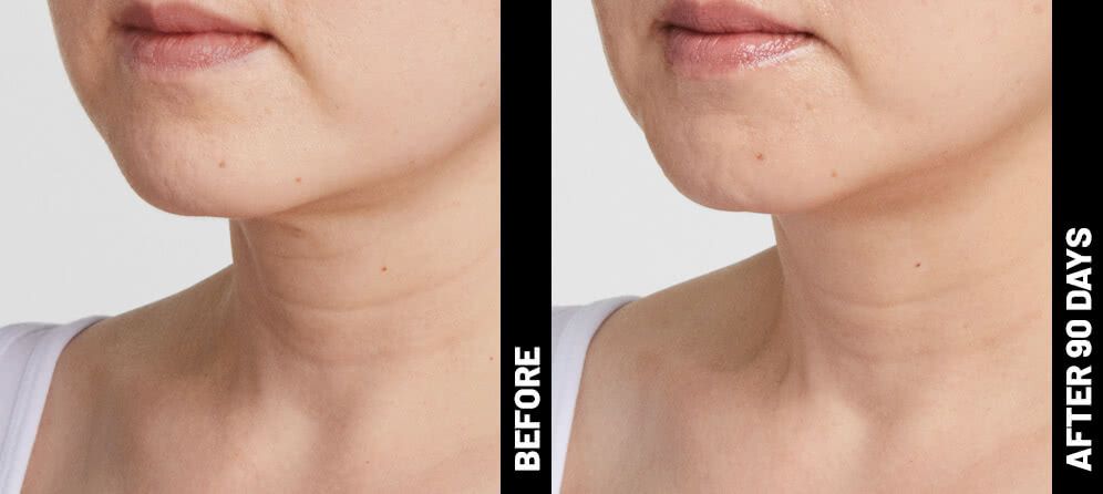 real patient shown before and after treatment with Ultherapy®