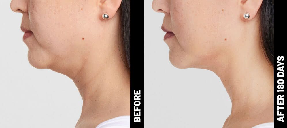 real patient shown before and after treatment with Ultherapy®