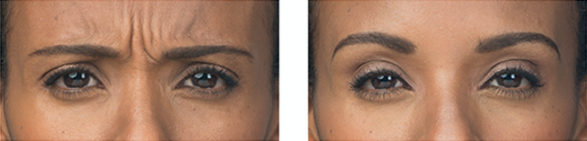 real patient before and after treatment with Botox injection
