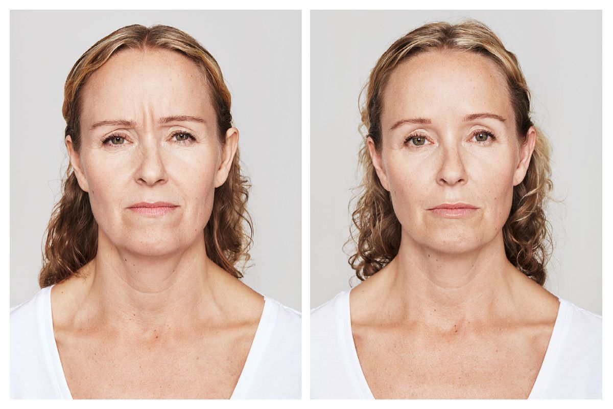 real patient before and after treatment with Dysport injection