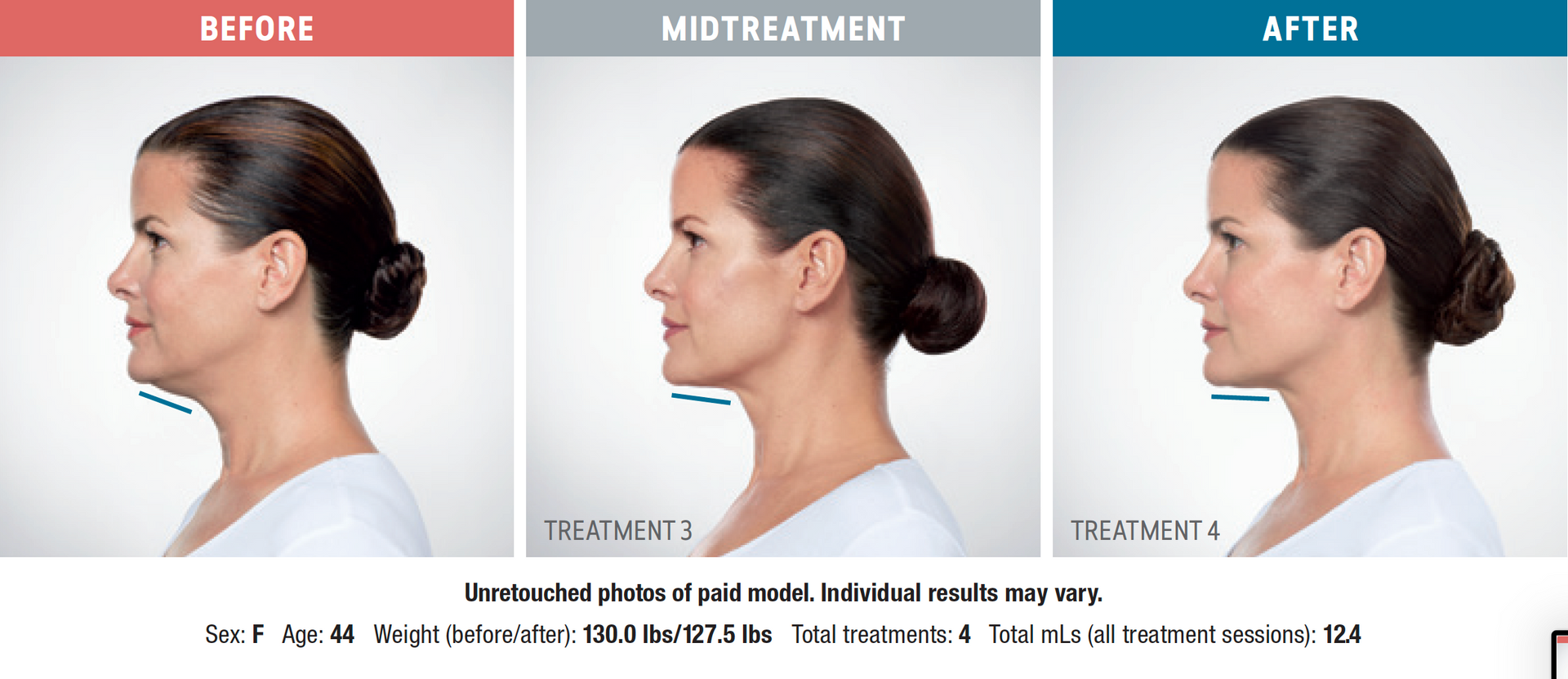 real patient shown before and after treatment with KYBELLA®