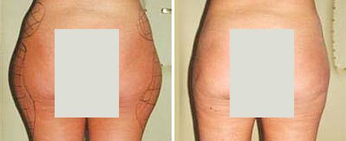 real patient shown before and after treatment with Fotona laser