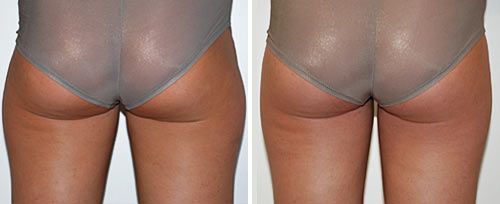 real patient shown before and after treatment with Fotona laser