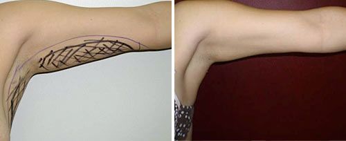 real patient shown before and after treatment with Fotona laser