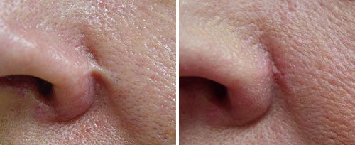 patient before and after treatment with Fotona laser