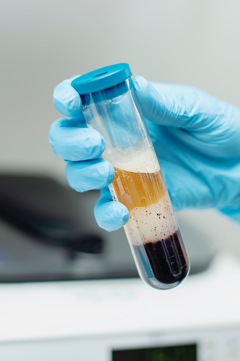 closeup of blood plasma in vial for PRP skin rejuvenation treatment