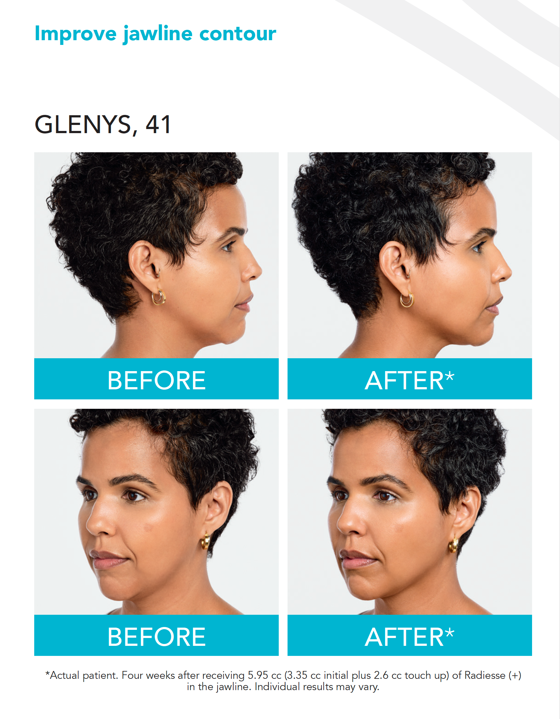 real patient shown before and after treatment with Radiesse