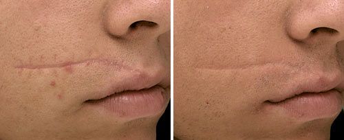 patient before and after treatment with Fotona laser