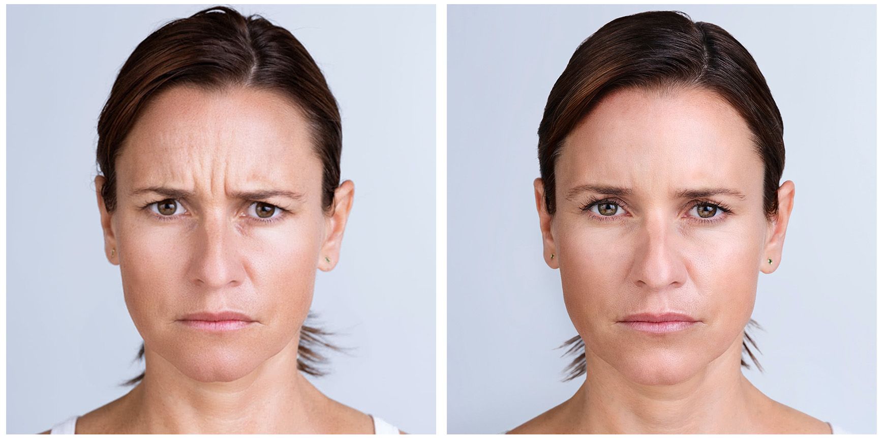 real patient before and after treatment with XEOMIN injection