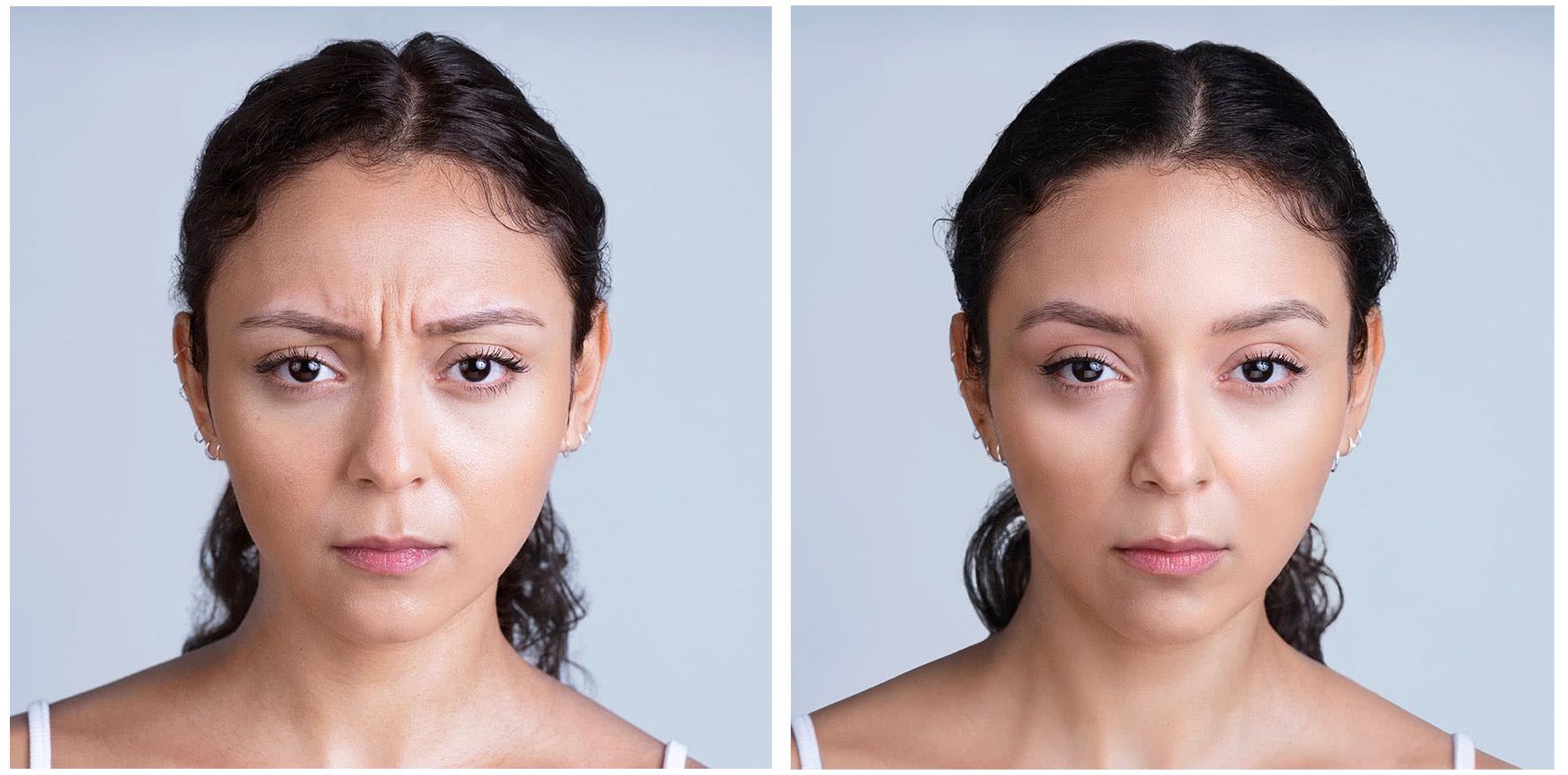 real patient before and after treatment with XEOMIN injection