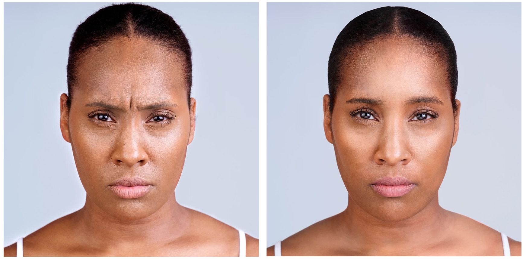 real patient before and after treatment with XEOMIN injection