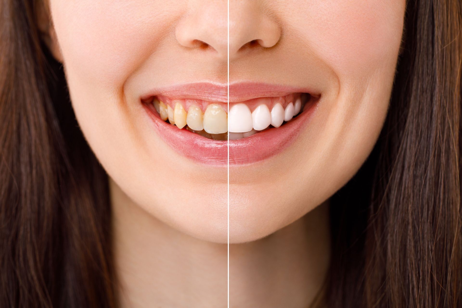 The Teeth Of A Woman Before And After Undergoing Whitening Treatment – Terrigal, NSW - Anjule Beauty Therapy