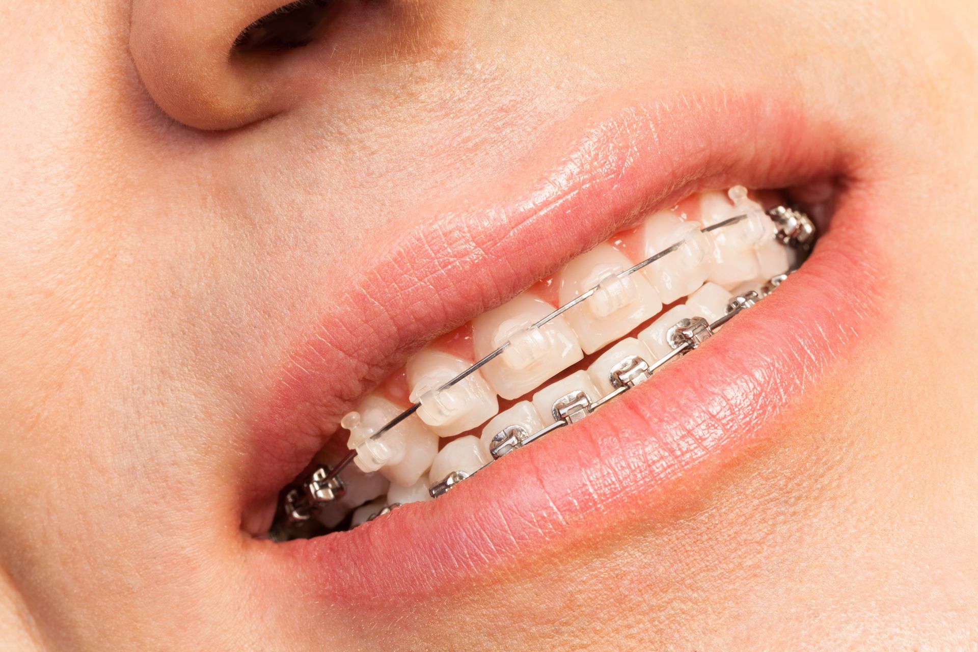 Close-up of lips with braces on the teeth, showing a slight smile.