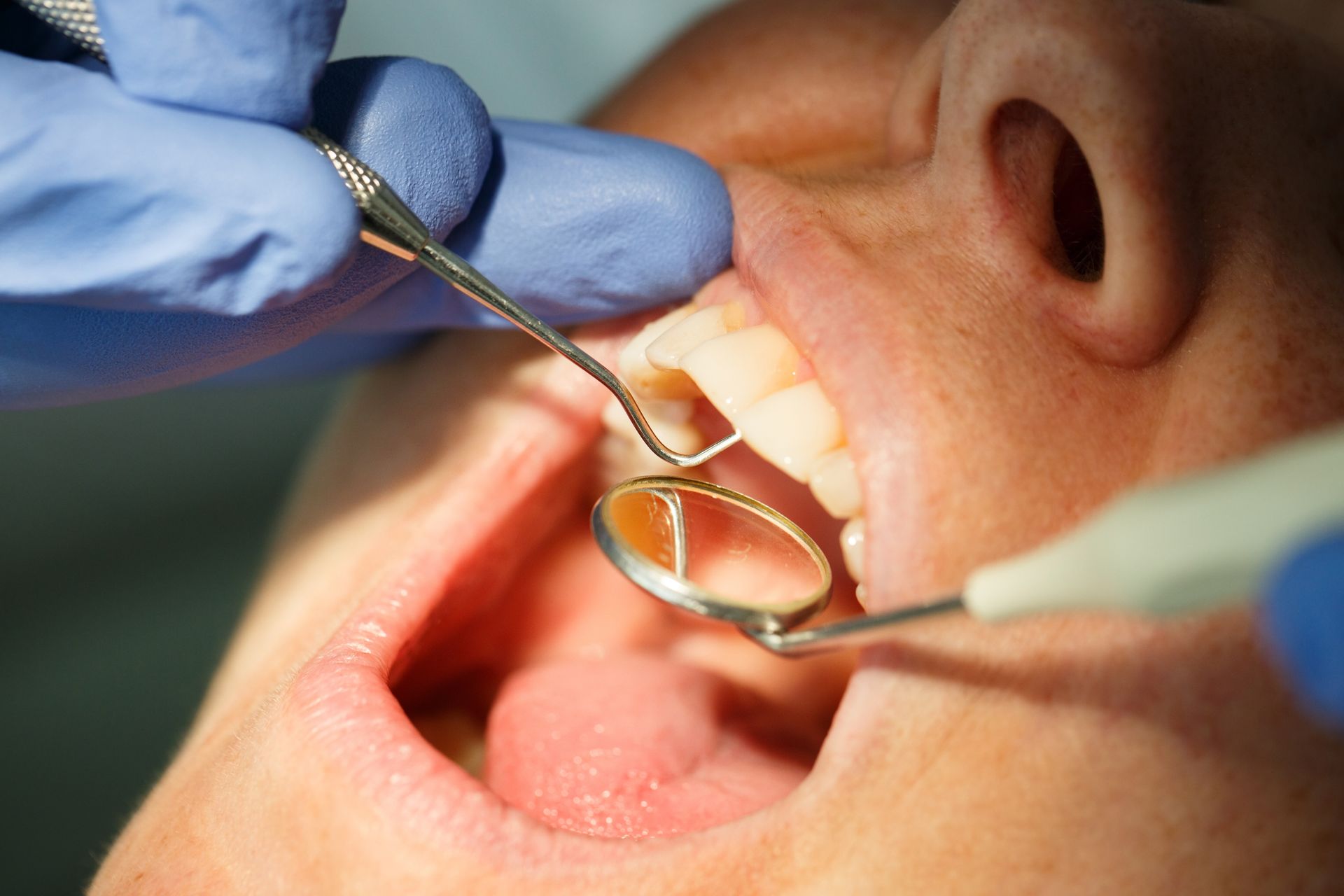 Dentist using a tool to work inside a patient’s open mouth