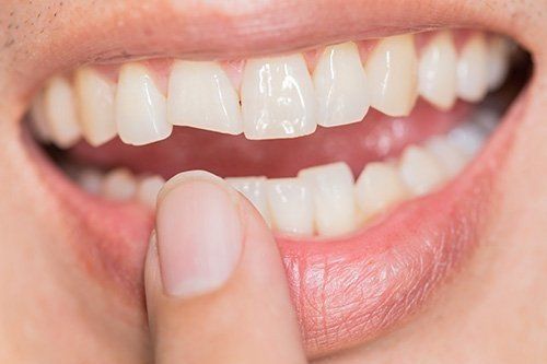 a close up of a person 's mouth with a broken tooth .