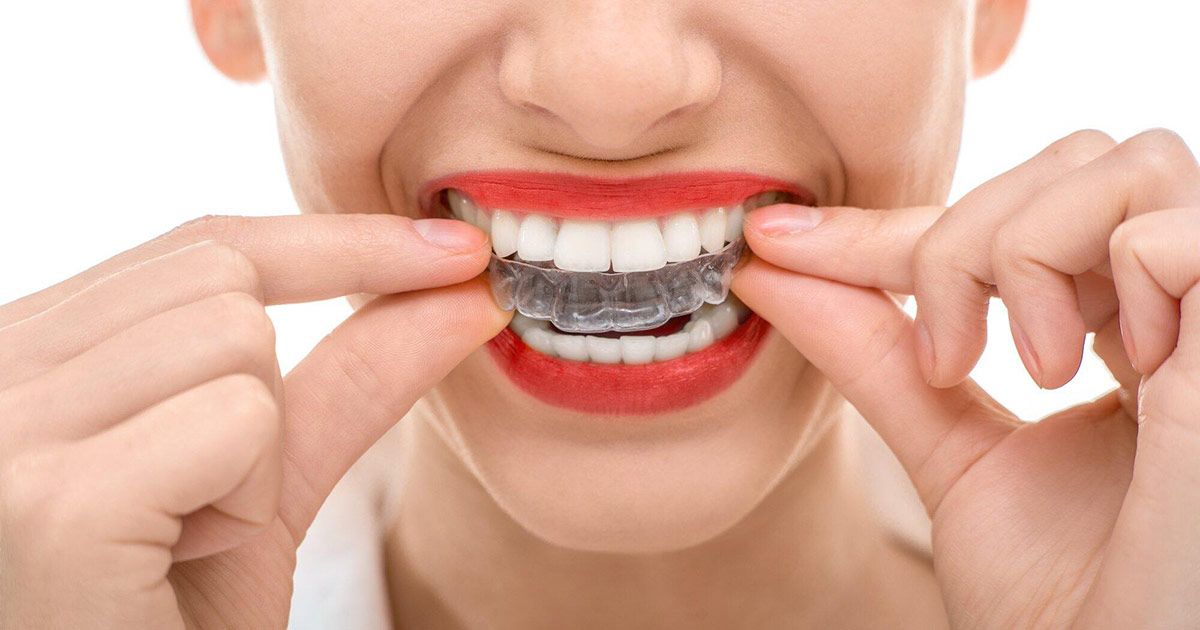 invisalign for adults