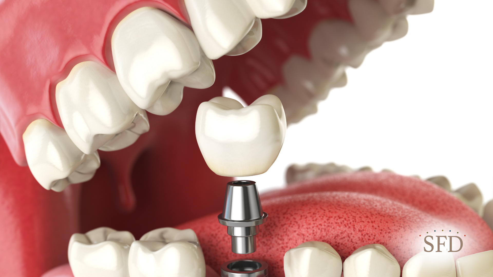 Dental implant: a tooth crown placed on a metal post, with open mouth, showing gums and teeth.