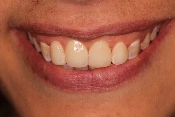 A close up of a woman 's smile with white teeth.