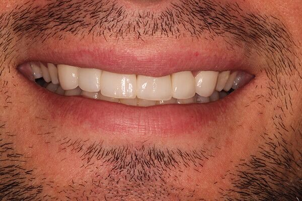 A close up of a man 's mouth with a beard and white teeth.
