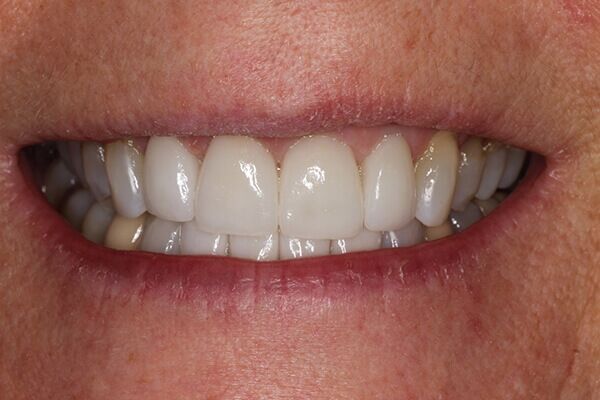 A close up of a person 's smile with white teeth.