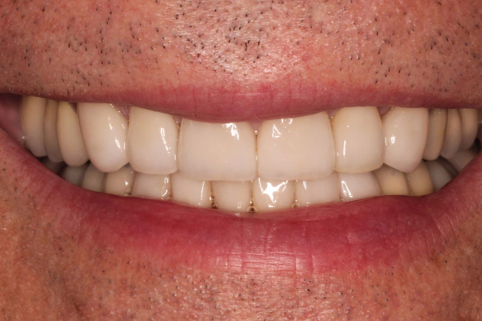 A close up of a man 's smile with white teeth.