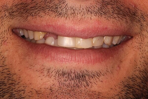 A close up of a man 's mouth with a beard and missing teeth.