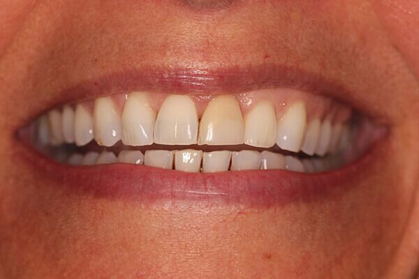 A close up of a woman 's mouth with white teeth.