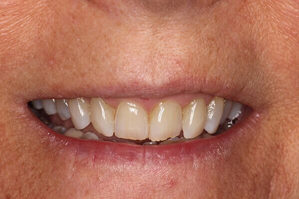 A close up of a person 's teeth and mouth.
