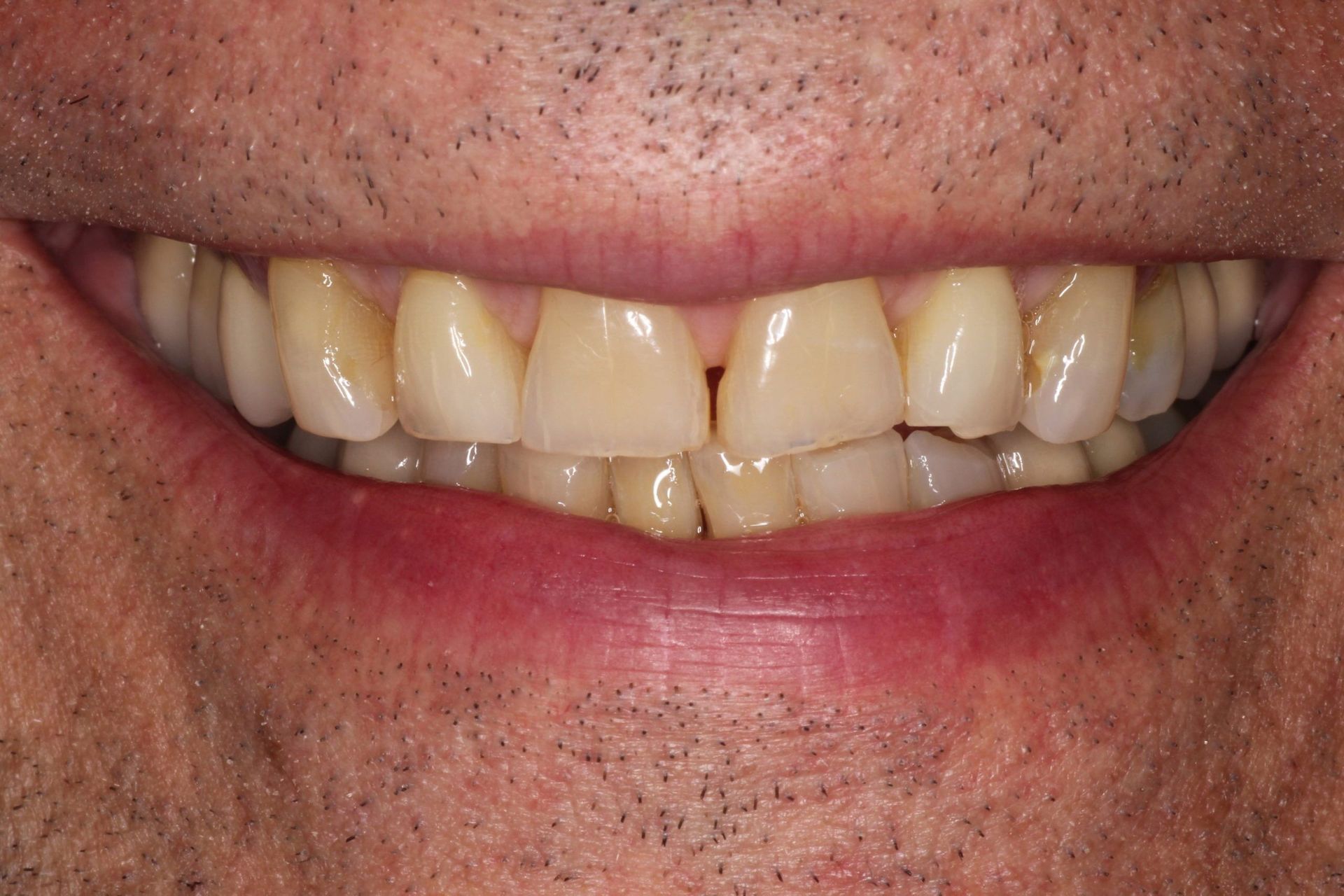 A close up of a man 's smile with a broken tooth.