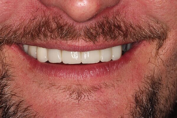 A close up of a man 's mouth with a beard and white teeth.