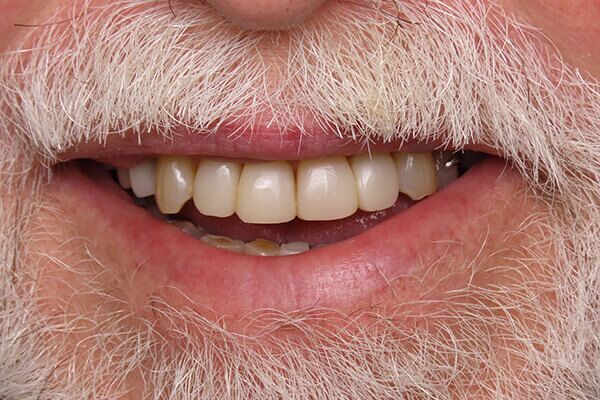 A close up of a man 's mouth with a beard and teeth.