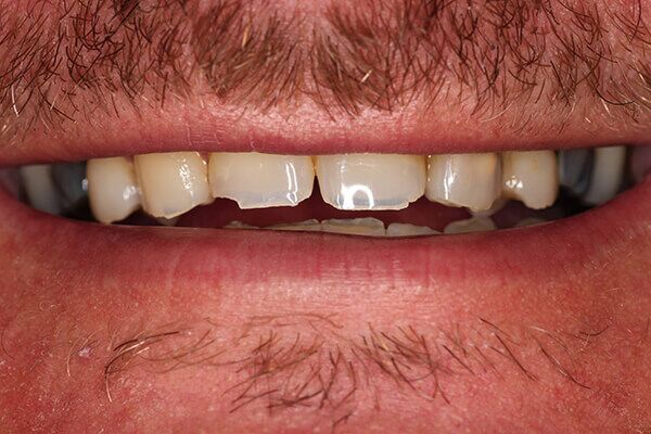 A close up of a man 's mouth with a broken tooth.