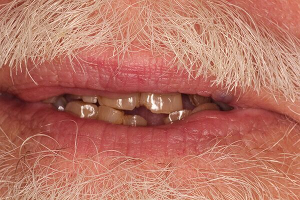 A close up of a man 's mouth with a beard and missing teeth.