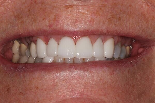 A close up of a person 's teeth with a healthy smile.