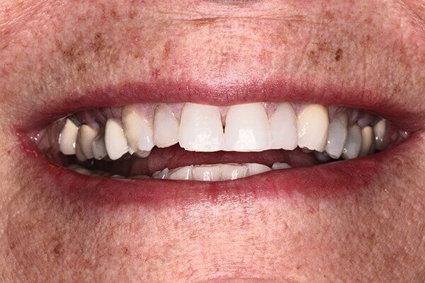 A close up of a woman 's mouth with missing teeth.