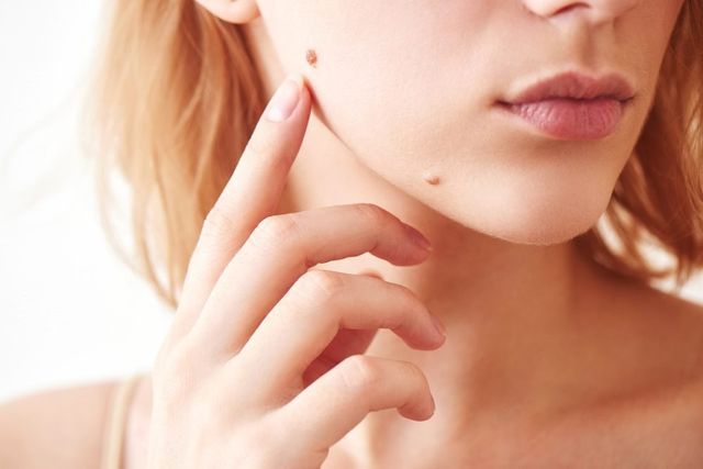 Close Up of a Woman 's Face With a Mole on It — Advanced Cosmetic & Beauty Clinic in Bundaberg South, QLD