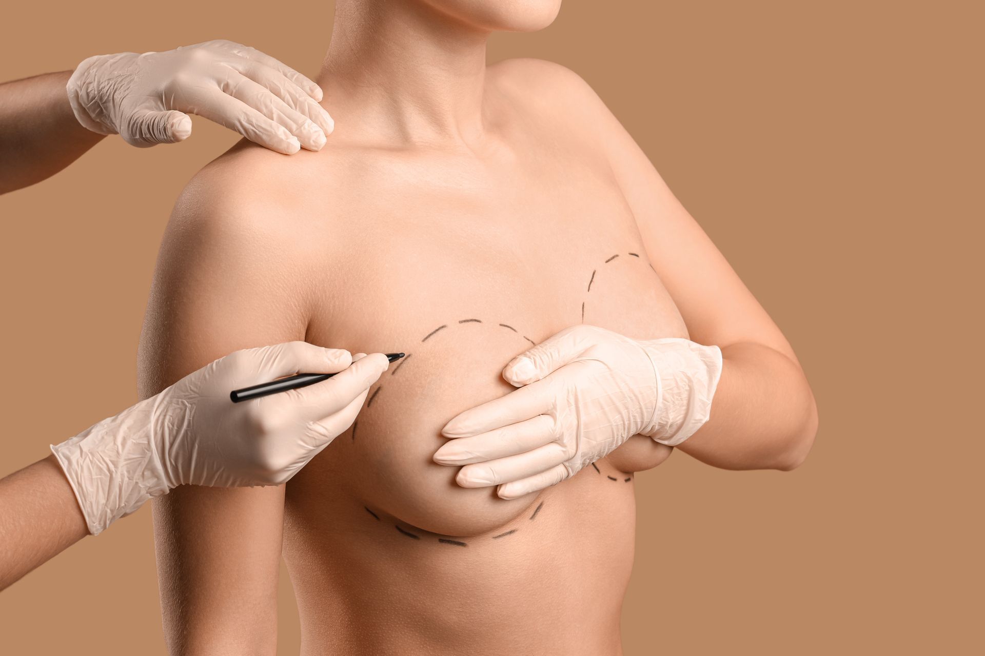 Mãos enluvadas marcando as linhas de incisão no peito de uma pessoa durante o planejamento de uma cirurgia estética de mama.