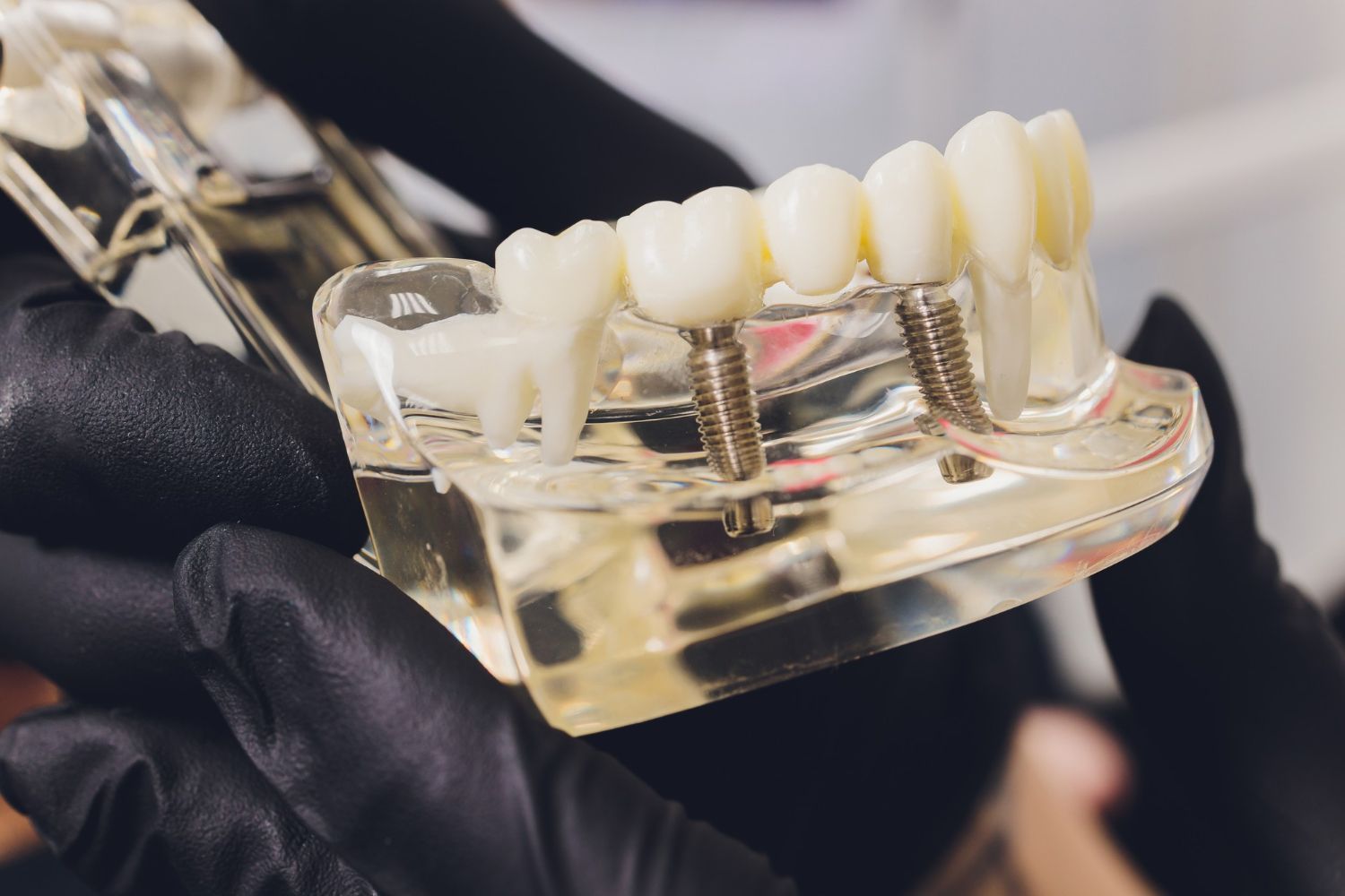 Denture model with two metal implants held in a gloved hand