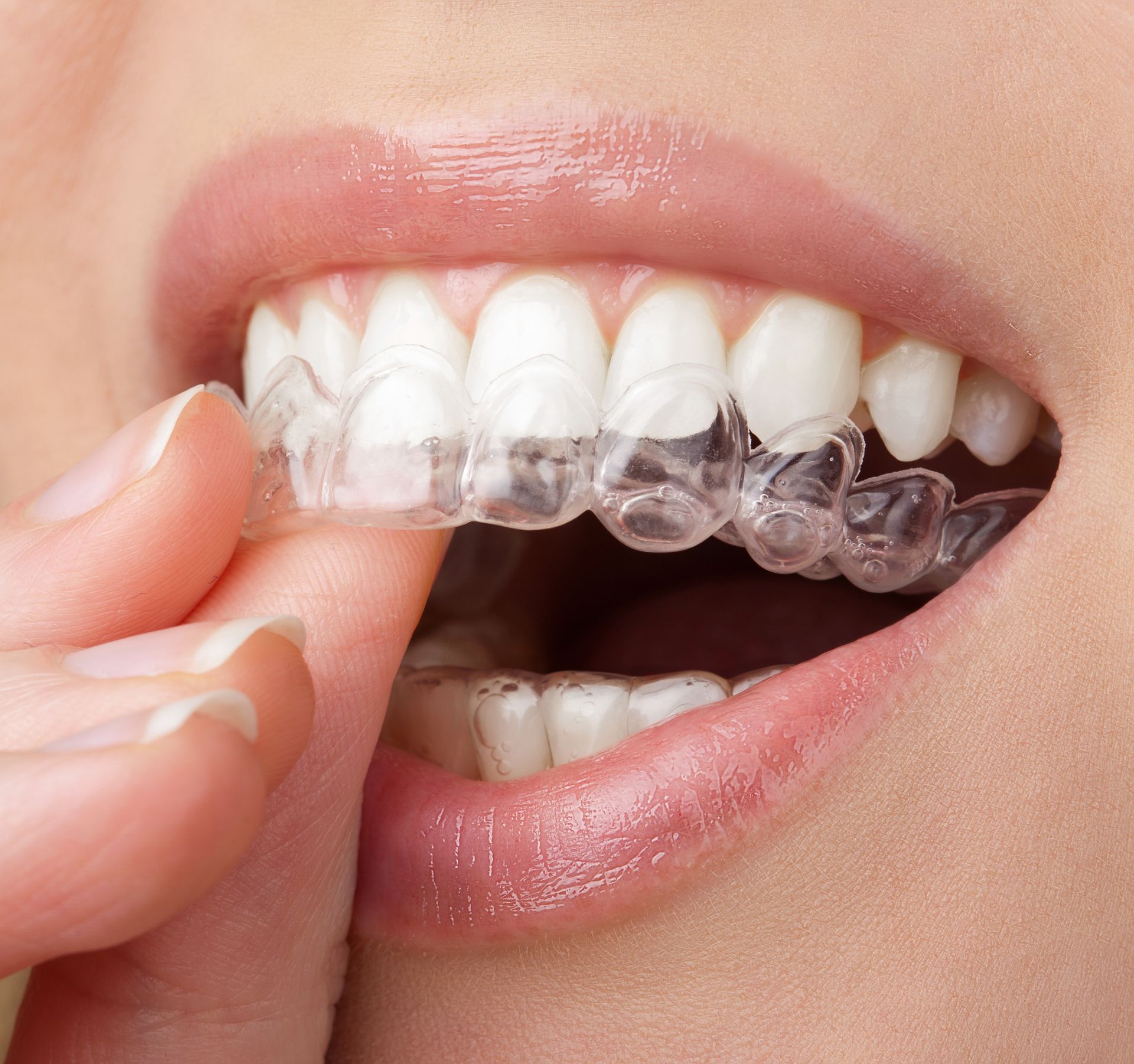 Clear dental aligner being removed from teeth with fingers.