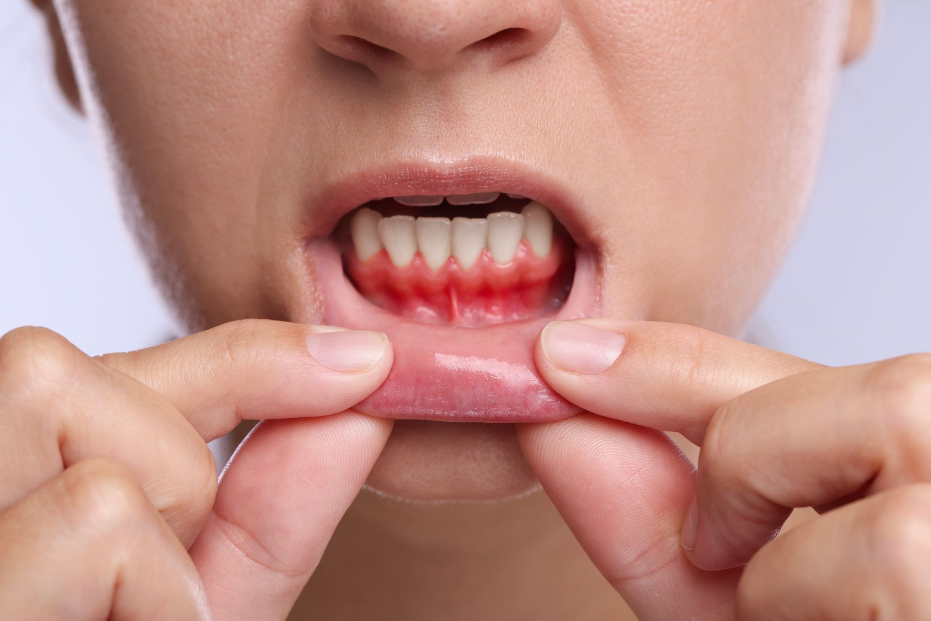 Person pulling down lower lip to show red, irritated gums and teeth