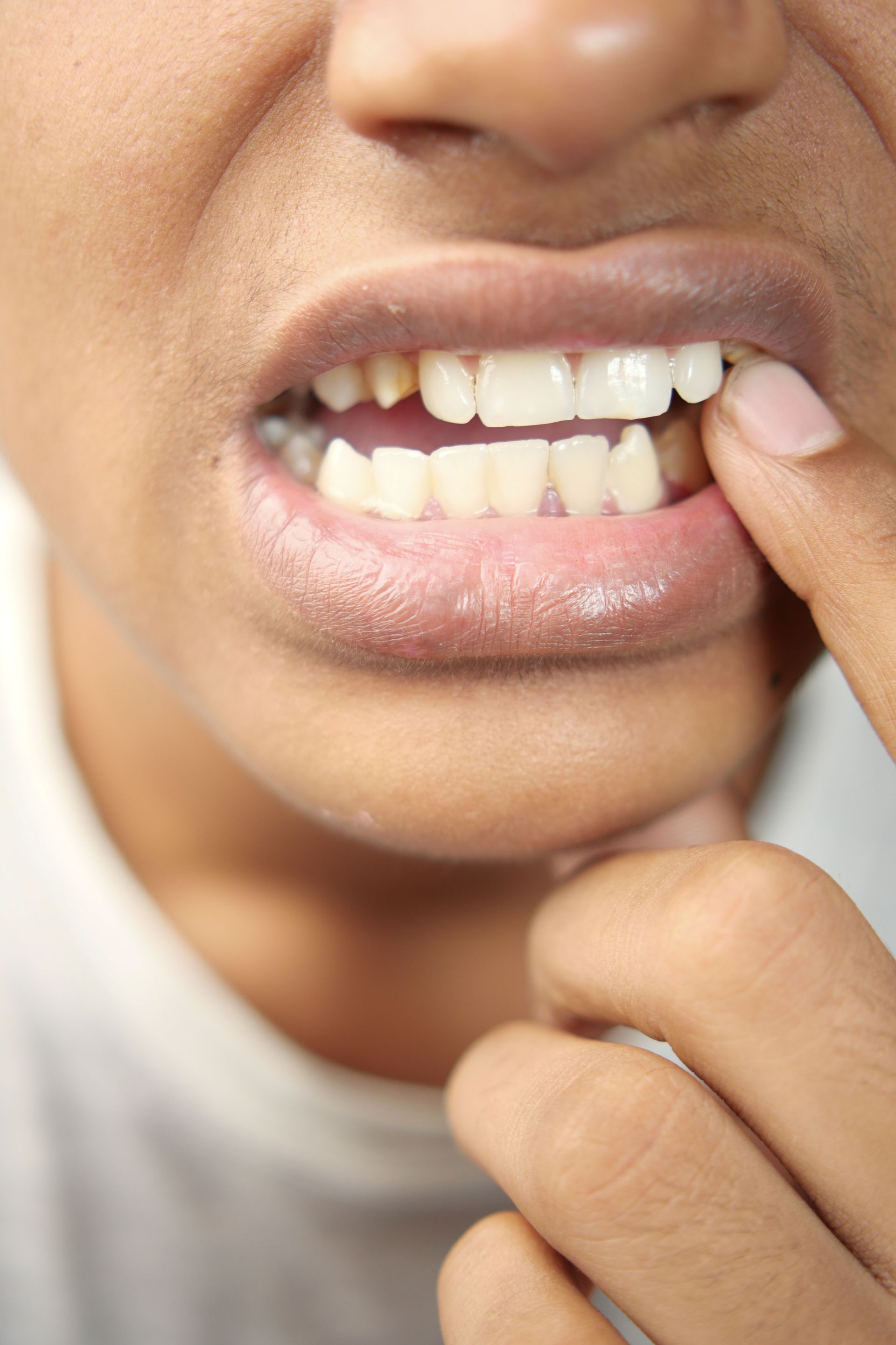 A person pulls back a lip to inspect a tooth, showing a close-up of their mouth.