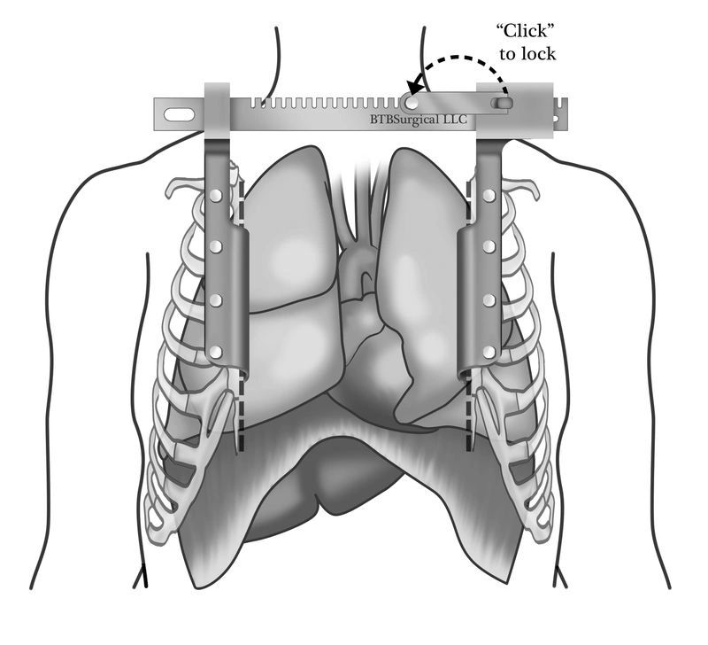 A black and white drawing of a person 's chest with a device attached to it.