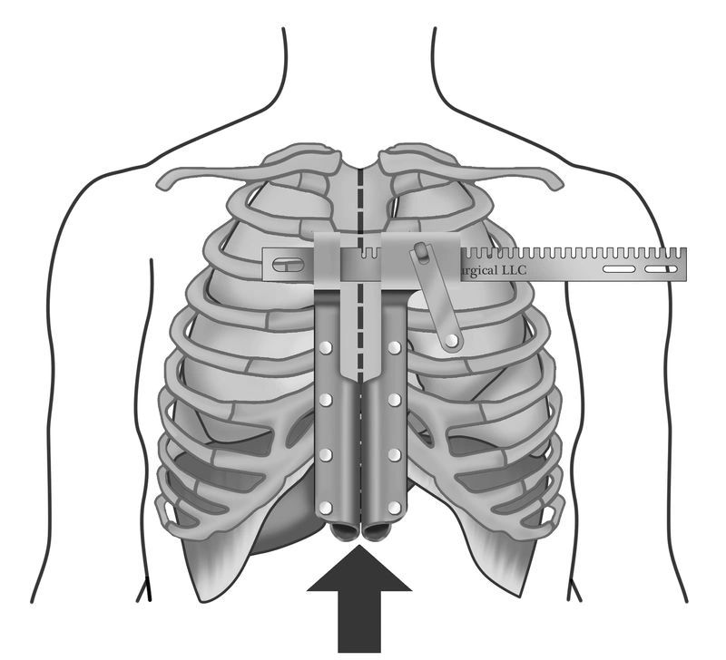 A black and white drawing of a person 's chest with an arrow pointing up.