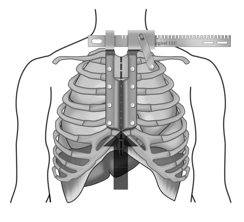 A drawing of a person 's chest with a measuring device attached to it.