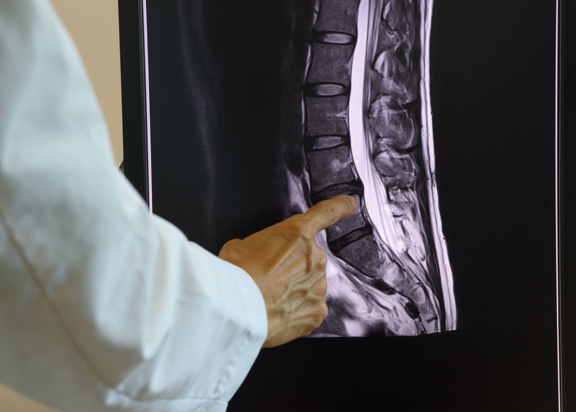Cirurgia de coluna para descompressão nervosa em Nova Friburgo Cirurgia de coluna para descompressão nervosa em Nova Friburgo