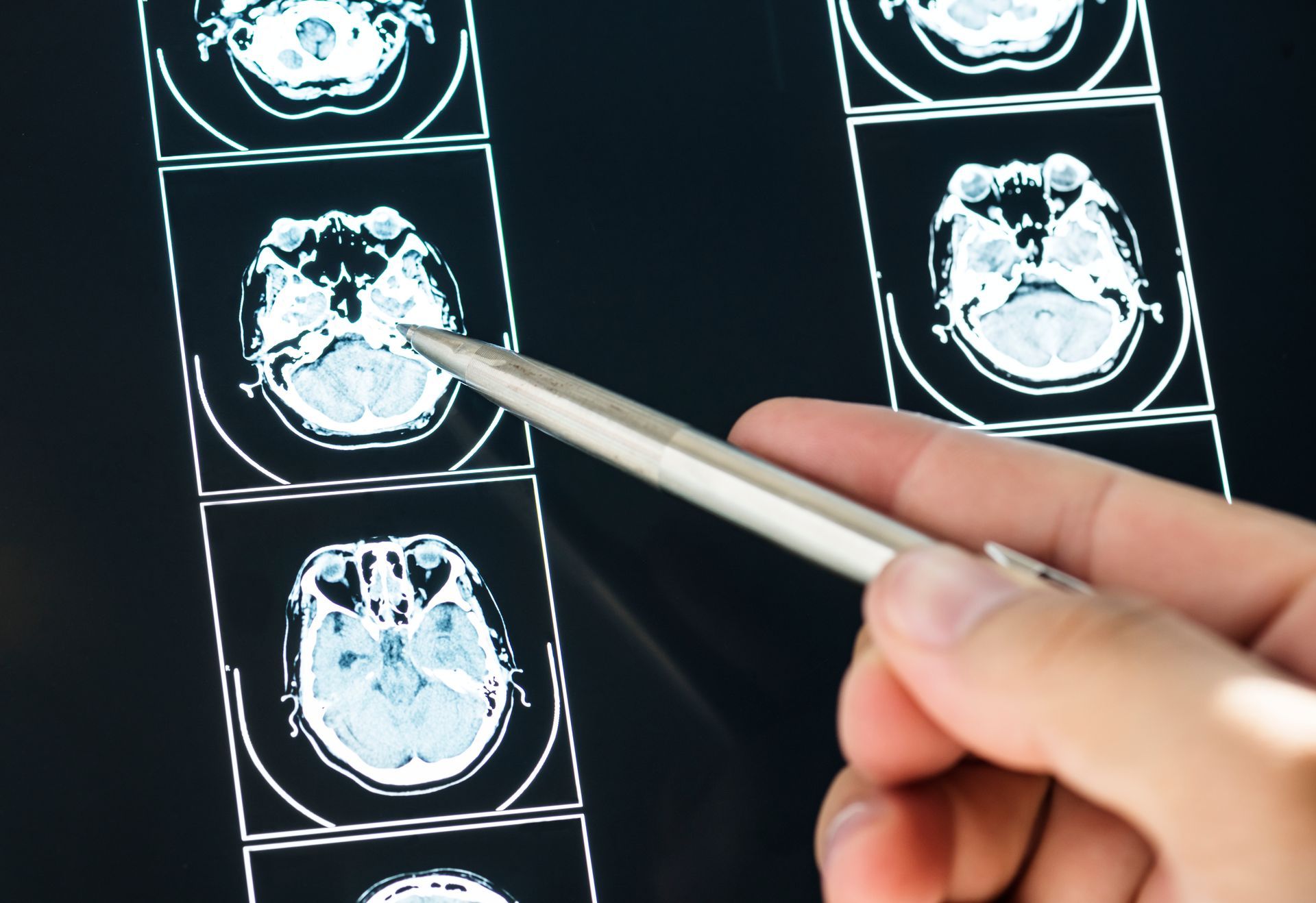 Tumor no cerebro tem cura Tumor no cerebro tem cura